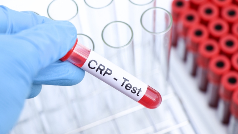 Epruveta sa uzorkom krvi označena kao CRP test koju laboratorijski tehničar drži