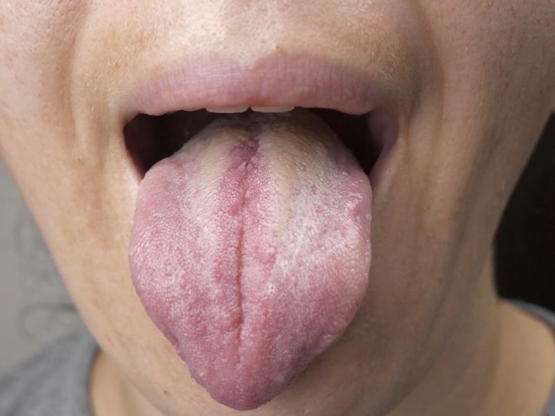 Devojka plazi jezik, jezik sa belim naslagama