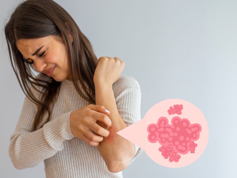 Žena češe lakat zbog kontaktnog dermatitisa sa vidljivim crvenilom i osipom