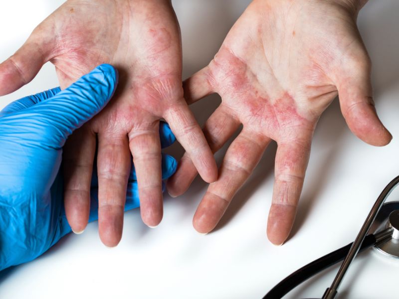 Kontaktni dermatitis na šakama sa crvenilom i ispucalom kožom tokom pregleda kod lekara
