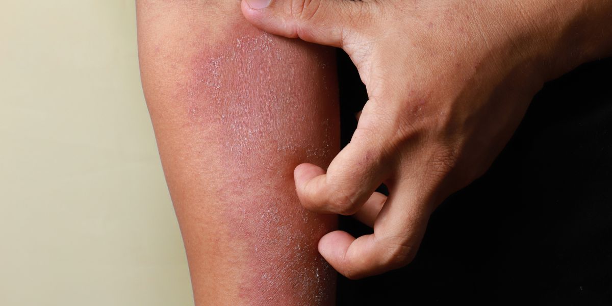 Kontaktni dermatitis – Šta je i kako ga prepoznati?