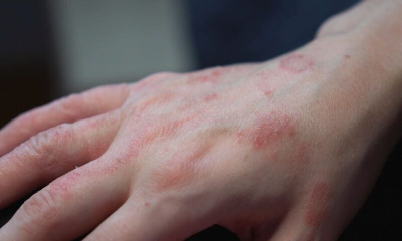 prikaz ekcema na rukama