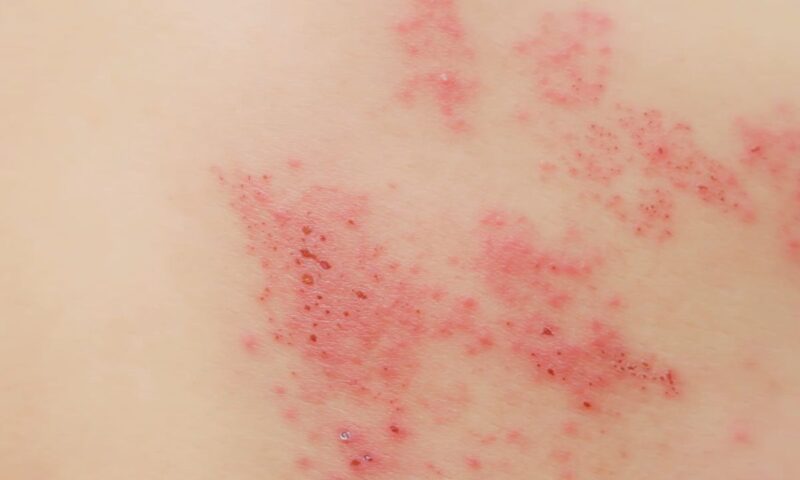 prikaz infekcije kože