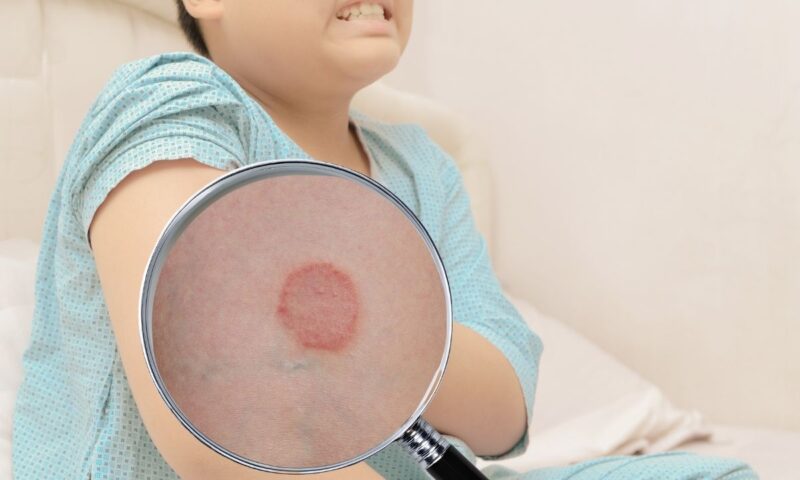 prikaz lišaja kod deteta