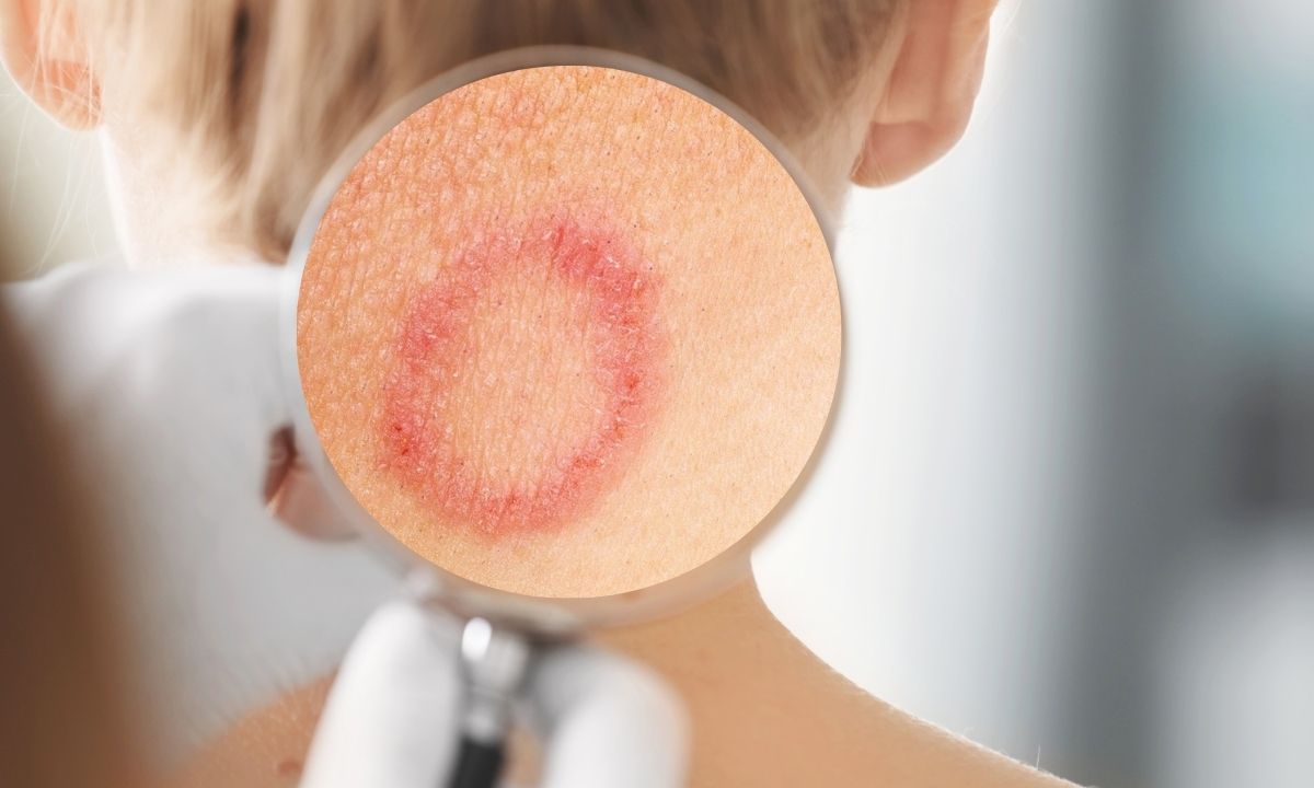 Lišaj na koži – uzroci, vrste, simptomi i lečenje