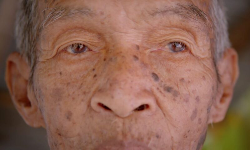 prikaz staračkih pega na licu kod starijeg čoveka