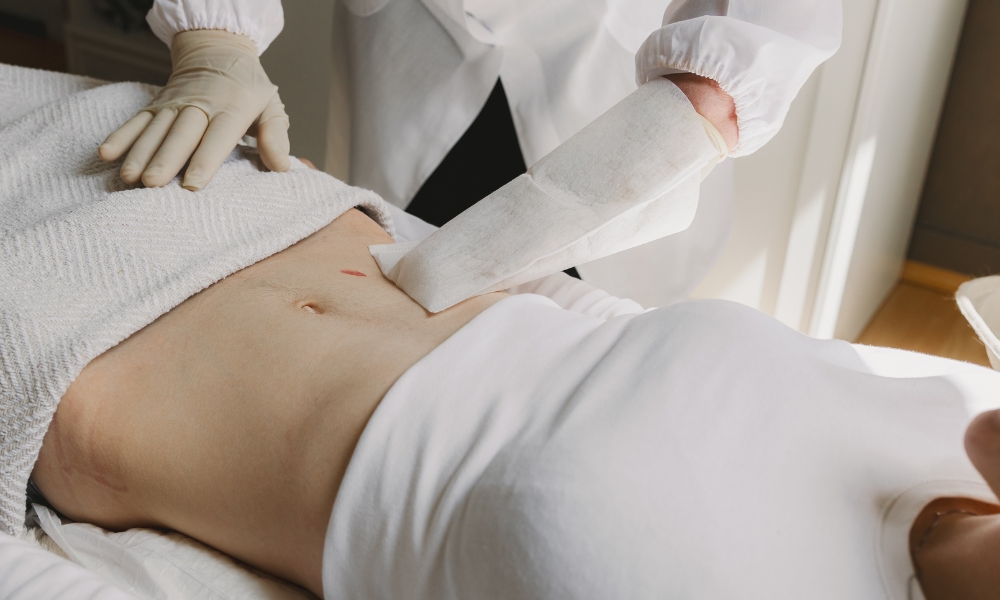 Kod odraslih je oporavak nakon operacije pupčane kile nešto sporiji nego kod dece i obično traje nekoliko nedelja