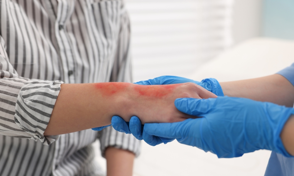 Prva pomoć kod opekotina: šta odmah uraditi (korak po korak)