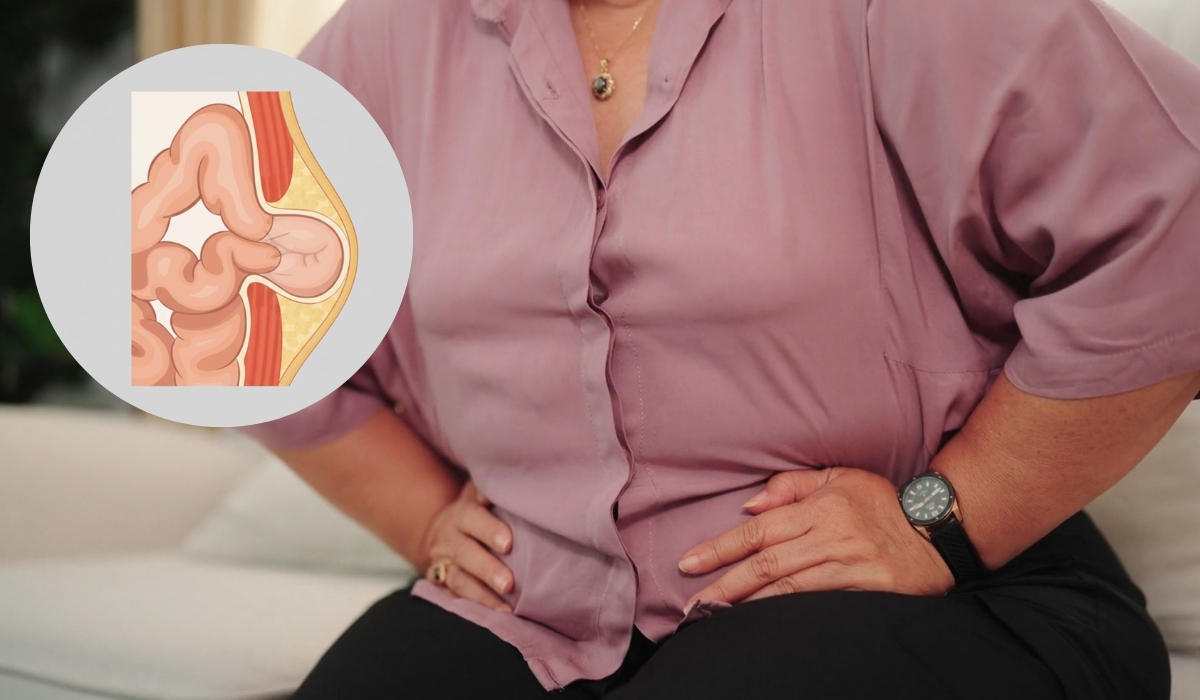 Pupčana kila: Simptomi, uzroci i put do izlečenja